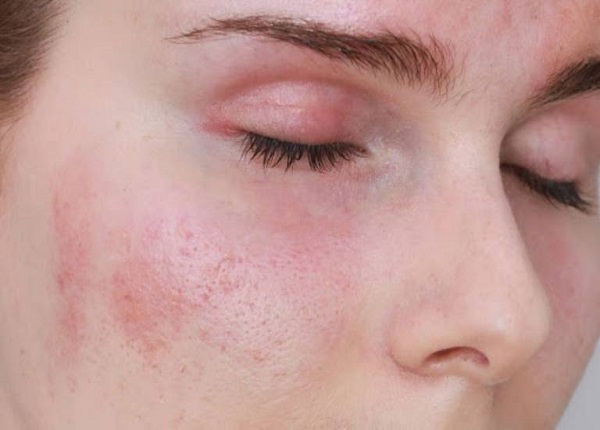 Viêm da tiếp xúc là một bệnh lý về da phổ biến