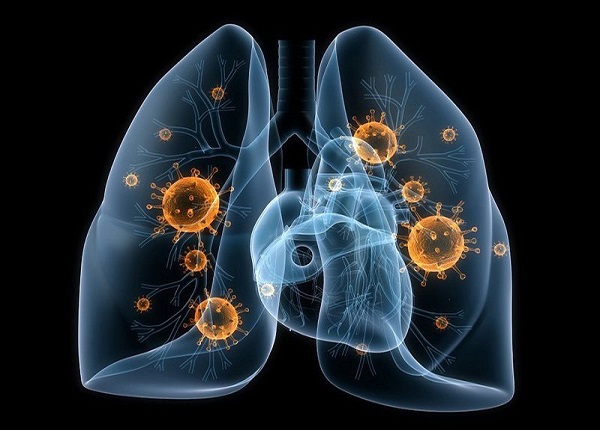 Viêm phổi do virus là căn bệnh không thể coi thường