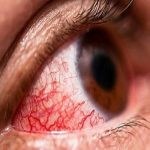 Tình trạng mắt nổi gân đỏ có thể khiến người bệnh lo lắng