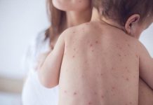 Bệnh sốt phát ban rất dễ lây lan