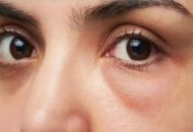 Sưng đau bọng mắt dưới thường không phải là dấu hiệu của bệnh lý nghiêm trọng
