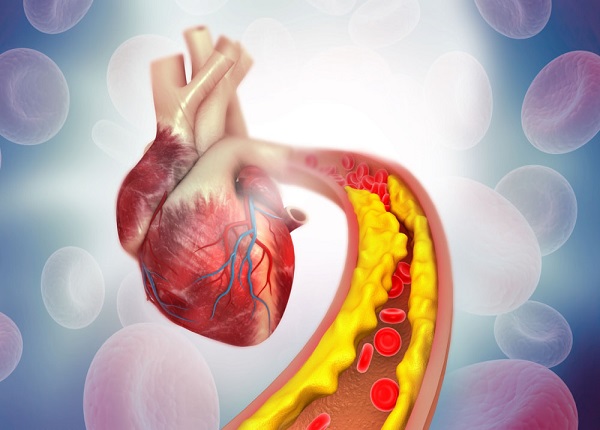 Cholesterol cao là nguyên nhân chính gây ra các bệnh tim mạch nguy hiểm