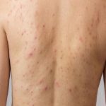 Mụn lưng có thể khiến nhiều ngươi e ngại