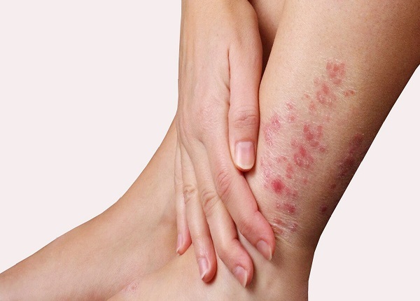 Nấm da là tình trạng da liễu gây ngứa ngáy, khó chịu