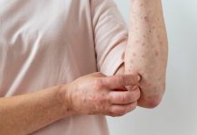 Phát ban da gây ngứa ngáy, khó chịu kéo dài nếu không được xử lý kịp thời