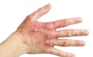Viêm da cơ địa là tình trạng da xuất hiện các mảng đỏ, ngứa và khô