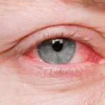 Đau mắt đỏ là bệnh lý phổ biến