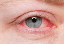 Đau mắt đỏ là bệnh lý phổ biến