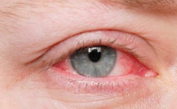 Đau mắt đỏ là bệnh lý phổ biến